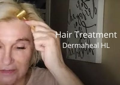 Hair Treatment with Dermaheal HL (Hair Loss Solution)