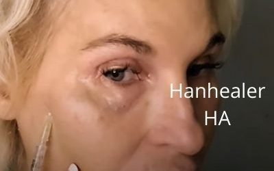 Hanhealer HA
