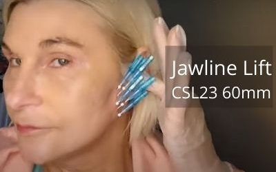 Jawline Lift with CSL23 Cog Threads 60mm