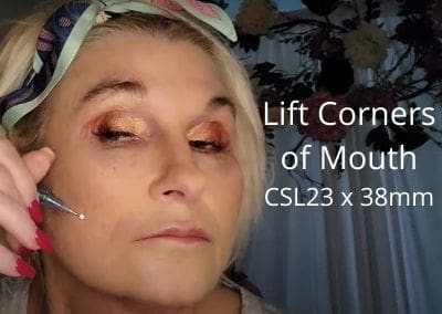 Lifting Down Turned Mouth – Corner Mouth Lift – PDO Cog Threads – CSL23 38mm