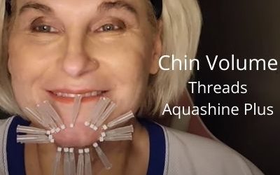 Volume in Chin with Aquashine Plus and Threads