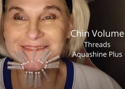 Volume in Chin with Aquashine Plus and Threads