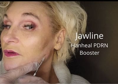 Jawline – Hanheal PDRN Booster