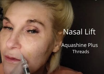 Nasal Lift with Aquashine Plus and Threads