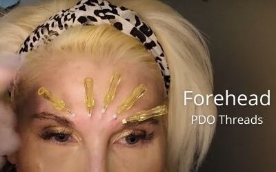 NeoGenius Threads for Forehead