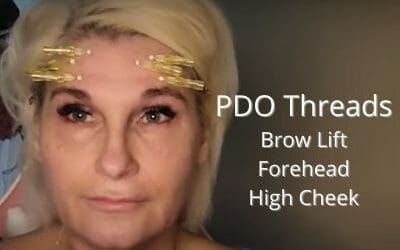 Brow and Cheek Lift with PDO Threads