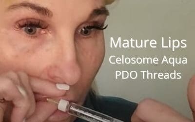 Plumping up Mature Lips for a Natural Look using Celosome Aqua and PDO Threads