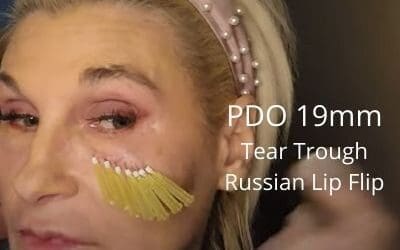 Tear Troughs and Russian Lip Flip –  PDO Threads 30g 19mm