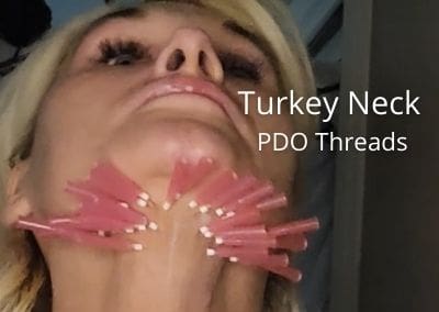 Treatment for Turkey Neck – Mature Skin – PDO Threads