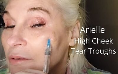 Meso with Arielle – High Cheeks & Tear Troughs