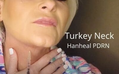 Treating a Turkey Neck with Hanheal PDRN