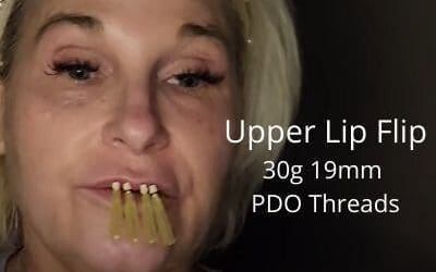 Upper Lip Flip using 30g 19mm PDO Threads
