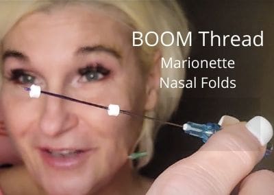 Boom Threads for Marionette Lines and Nasolabial Folds