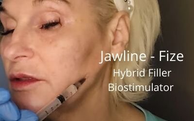 Working on my Jawline with Fize – Hybrid Filler Biostimulator