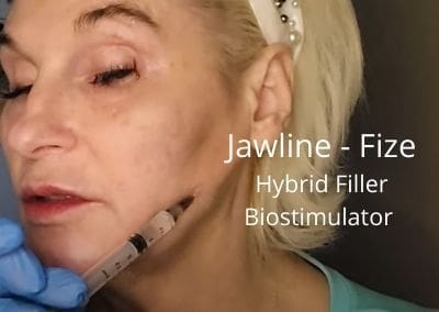 Working on my Jawline with Fize – Hybrid Filler Biostimulator