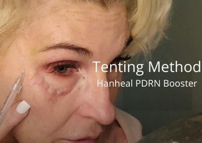 Crows Feet and Tear Troughs – Tenting Method with Hanheal PDRN