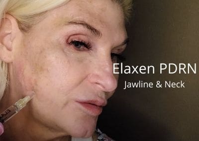Elaxen PDRN – Meso for Jawline and Neck