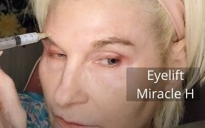 Eyelift using Miracle H PCL