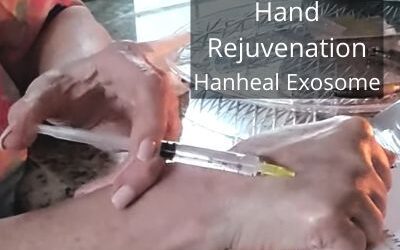 Hand Rejuvenation with Hanheal Exosome