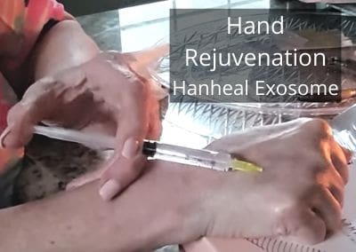 Hand Rejuvenation with Hanheal Exosome