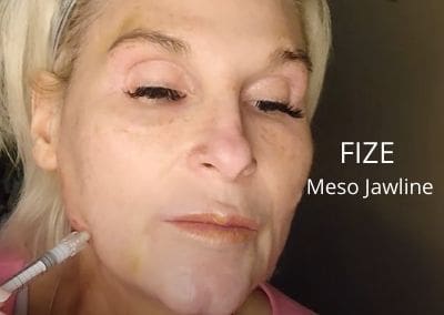 Jawline – Meso with FIZE