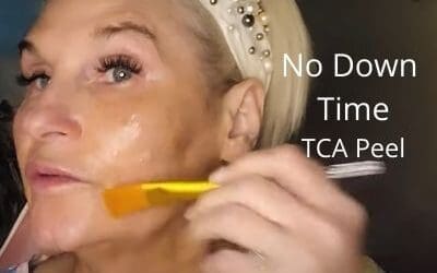 TCA Peel – No Down Time –  SOONSU Shining TCA + Retinol Peel