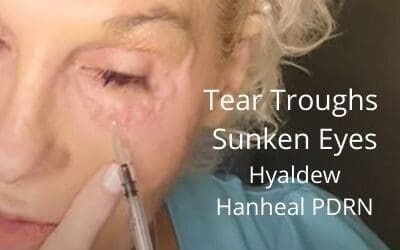 Tear Troughs / Sunken Eyes – Hyaldew Hanheal PDRN