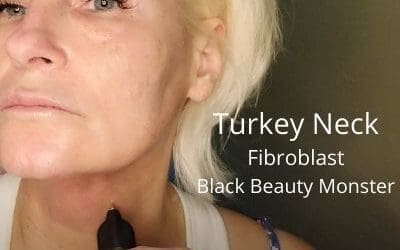 Turkey Neck – Fibroblast with Black Beauty Monster