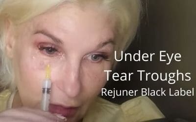 Under Eye – Tear Trough – Rejuner – Biostimulator