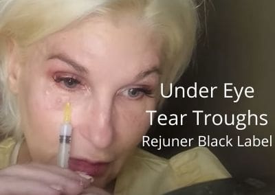 Under Eye – Tear Trough – Rejuner – Biostimulator