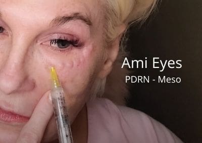 Ami Eyes PDRN – Meso
