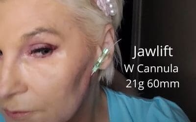 Jawlift with W Cannula – 21g 60mm