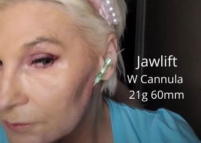 Jawlift with W Cannula – 21g 60mm