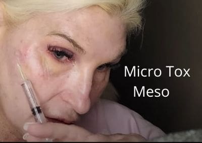Micro Tox Meso – Benefits