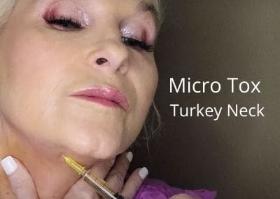Micro Tox – Turkey Neck