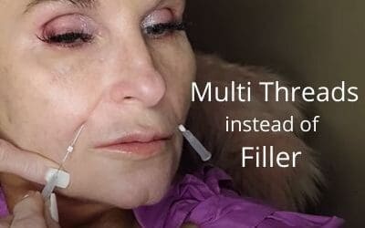 Multi Threads instead of Filler for the Down Turned Mouth