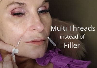 Multi Threads instead of Filler for the Down Turned Mouth