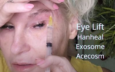 Eye Lift with Hanheal Exosomes from Acecosm