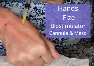 Hands – Fize Biostimulator with Cannula & Meso