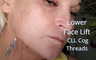 Lower face lift with CLL Cog Threads from Acecosm