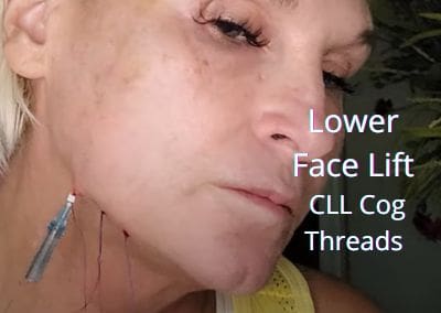 Lower face lift with CLL Cog Threads from Acecosm