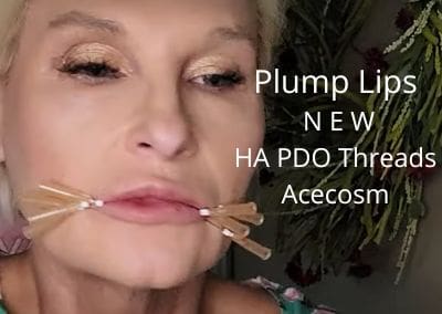 Plump those Lips with NEW HA PDO threads from Acecosm