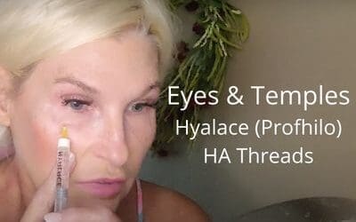 Working on Eyes & Temples – Hyalace (Profhilo) & HA Threads