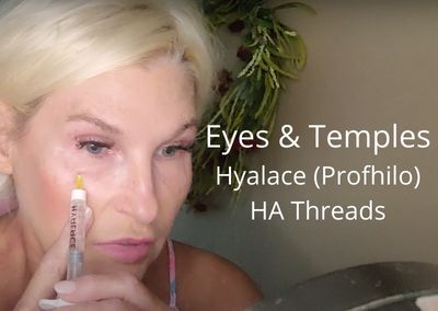Working on Eyes & Temples – Hyalace (Profhilo) & HA Threads