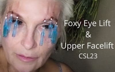 Foxy Eye Lift and Upper Facelift – CSL23