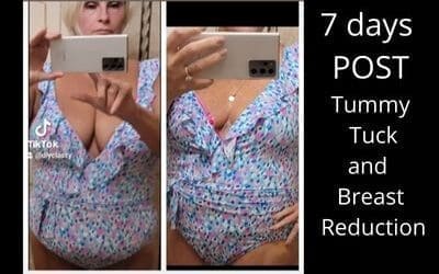 7 days Post- Tummy Tuck and Breast Reduction – Over 50