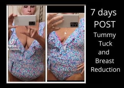 7 days Post- Tummy Tuck and Breast Reduction – Over 50