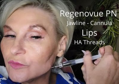 Regenovue PN for the Jawline using a Cannula and HA Threads for Lips