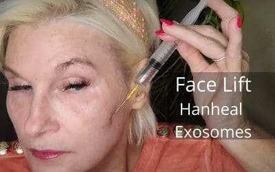 Facelift with Hanheal Exosomes and Cannula