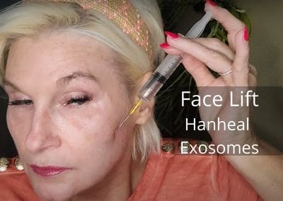 Facelift with Hanheal Exosomes and Cannula
